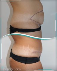 Abdominoplastia - Dra. Estefanía Poza Guedes