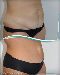 Abdominoplastia - Dra. Estefanía Poza Guedes