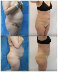 Abdominoplastia - Dra. Estefanía Poza Guedes