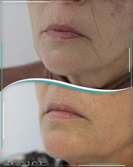 Rellenos faciales - Dra. Estefanía Poza Guedes