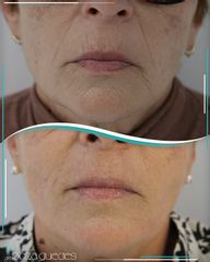 Rellenos faciales - Dra. Estefanía Poza Guedes