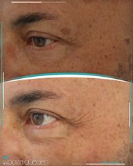Rellenos faciales - Dra. Estefanía Poza Guedes