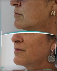Rellenos faciales - Dra. Estefanía Poza Guedes