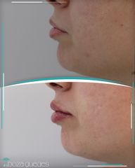 Aumento de labios - Dra. Estefanía Poza Guedes