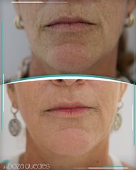 Rellenos faciales - Dra. Estefanía Poza Guedes