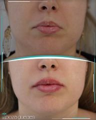 Aumento labios - Dra. Estefanía Poza Guedes