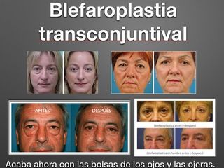 Blefaroplastia