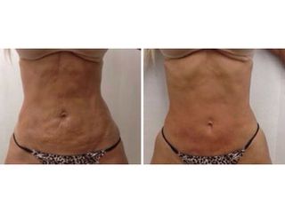 Antes y después Lipolaser - Clínica Lasery