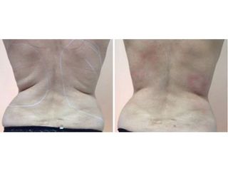 Antes y después Lipolaser - Clínica Lasery