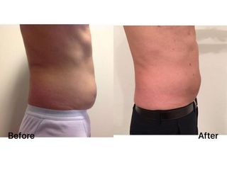 Antes y después Lipolaser - Clínica Lasery