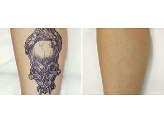 Eliminación de tatuajes - 856245