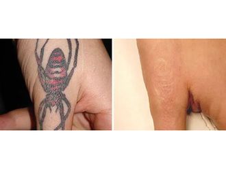 Eliminación de tatuajes - 856246