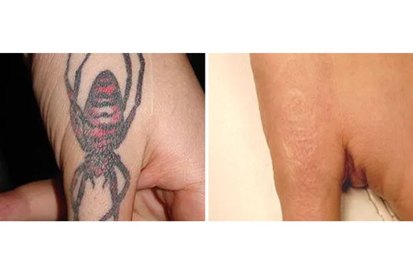 Eliminación de tatuajes antes y después - 856246