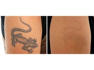 Eliminación de tatuajes - 856248