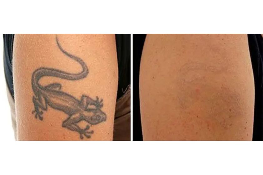 Eliminación de tatuajes antes y después - 856248