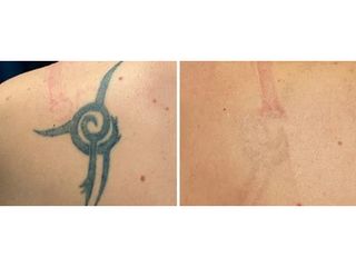 Eliminación de tatuajes - Clínica Lasery