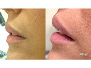 Aumento de labios - Clínica Lasery