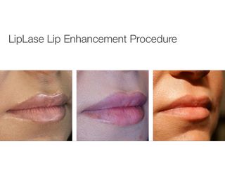 Aumento de labios - Clínica Lasery