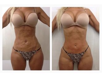 Lipoláser antes y después - 874257