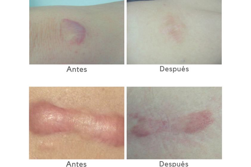 Corrección cicatrices antes y después - 874259
