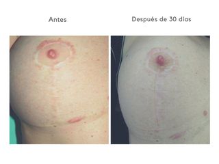 Corrección cicatrices - Clínica Lasery