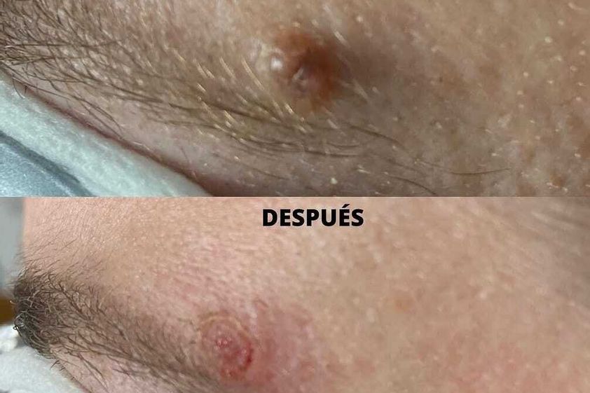 Verrugas antes y después - 881686