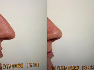 Rinomodelación antes y después - 881691