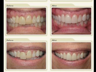 Carillas dentales - 482742