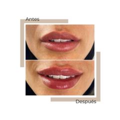 Aumento de labios - Dra. Lorena García Cubas