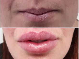 Aumento labios - 634955