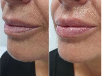 Aumento labios - 641090