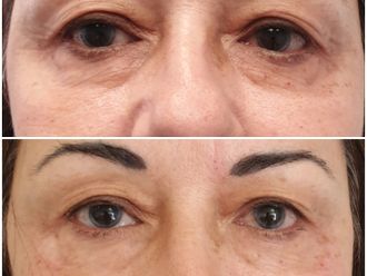 Blefaroplastia - 645281