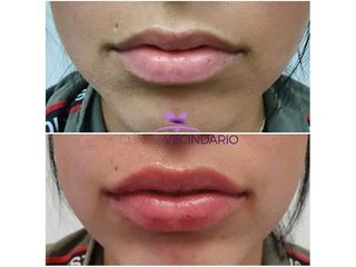 Aumento de labios - Clínica Vecindario