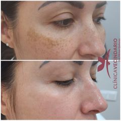 Resultado del Tratamiento de Eliminación de manchas con Láser Picosure - Clínica Vecindario