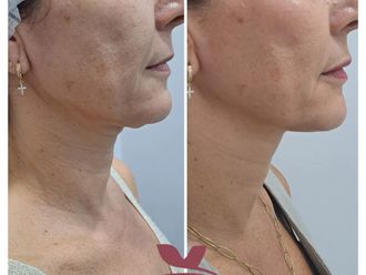 Rejuvenecimiento facial antes y después - 874557