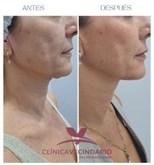 Resultado del LIPODEFINE