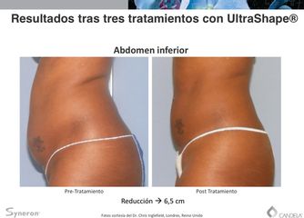 Resultados tras tres tratamientos con UltraShape