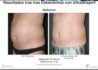 Resultados tras tres tratamientos con UltraShape