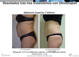 Resultados tras tres tratamientos con UltraShape