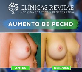 Aumento de pecho - Clínicas Revitae