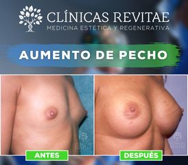 Aumento de pecho - Clínicas Revitae
