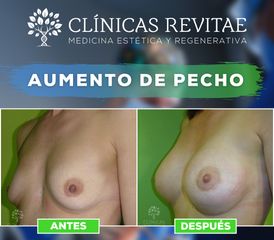 Aumento de pecho - Clínicas Revitae