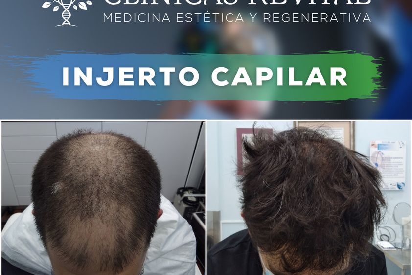 Trasplantes capilares antes y después - 831333