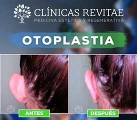 Otoplastia - Clínicas Revitae