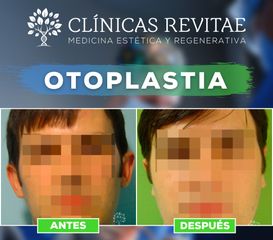 Otoplastia - Clínicas Revitae