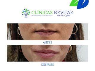 Aumento de labios - Clínicas Revitae