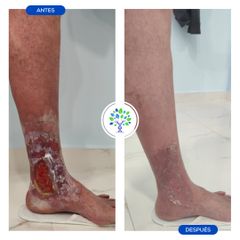 Tratamiento varices - Clínicas Revitae