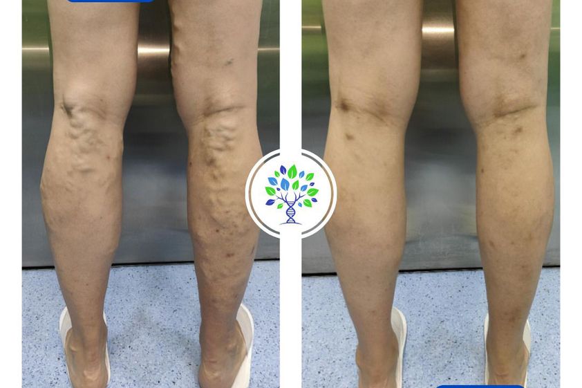 Tratamiento varices antes y después - 865599