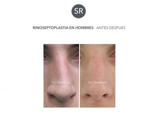 Antes y después Rinoseptoplastia 