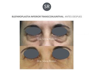 Antes y después Blefaroplastia transconjuntival 